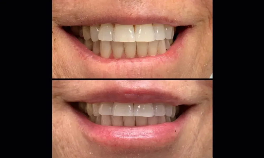 Clinical photo from Sally's lip enhancement case
